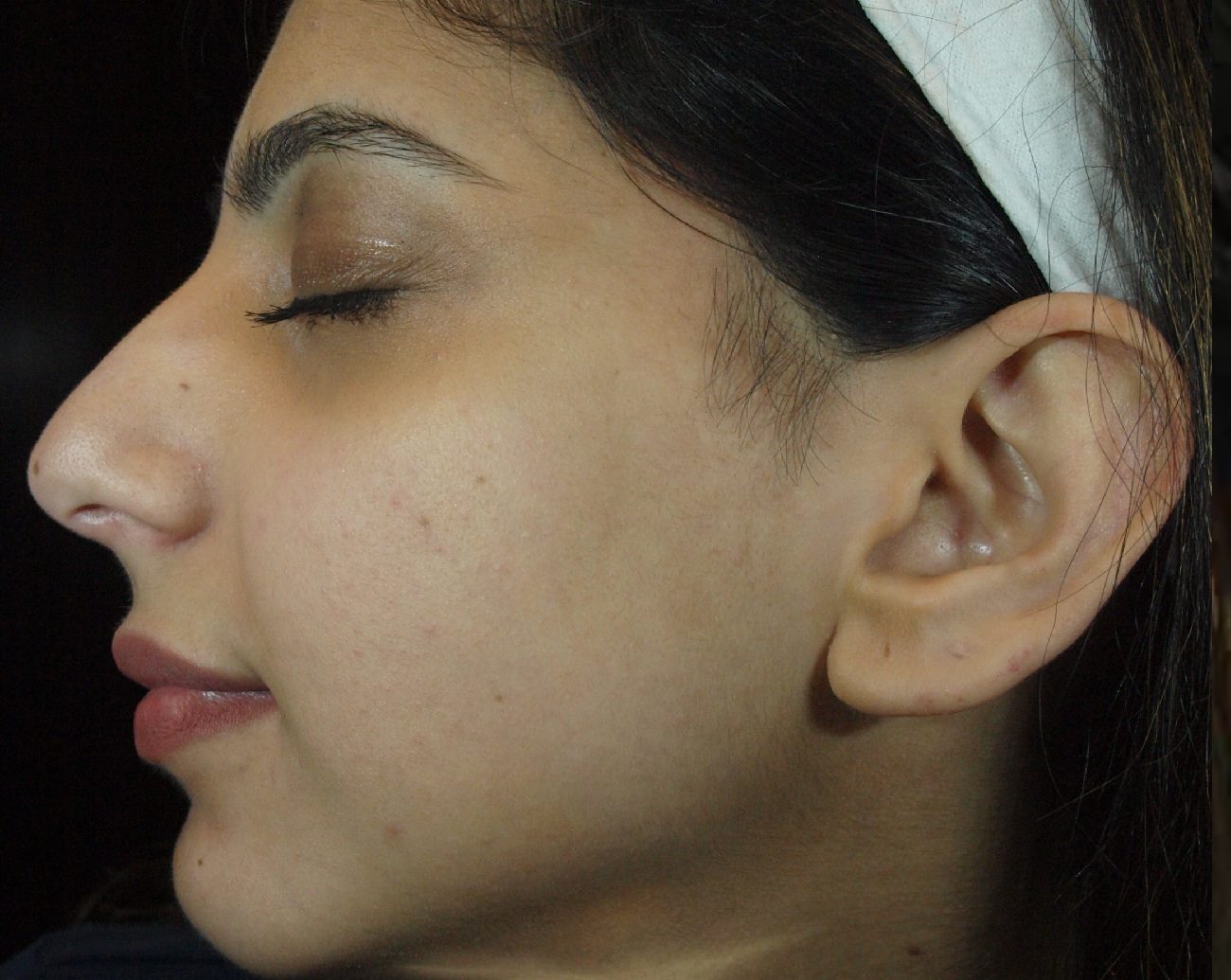 Face of a young woman before PRP Facelift in East Brunswick NJ