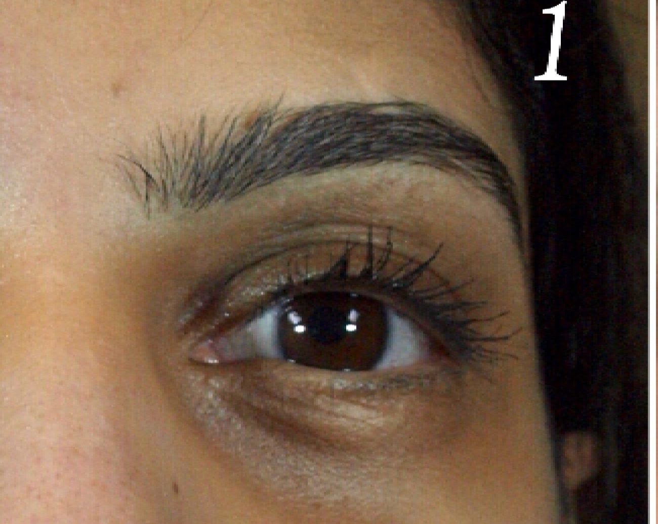 Under eye hollowness and darkening in a woman before PRP injection