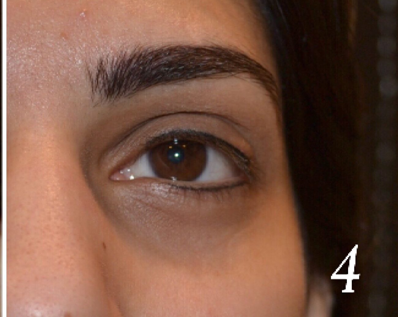Under eye hollowness and darkness improved in a woman after PRP treatments in East Brunswick NJ