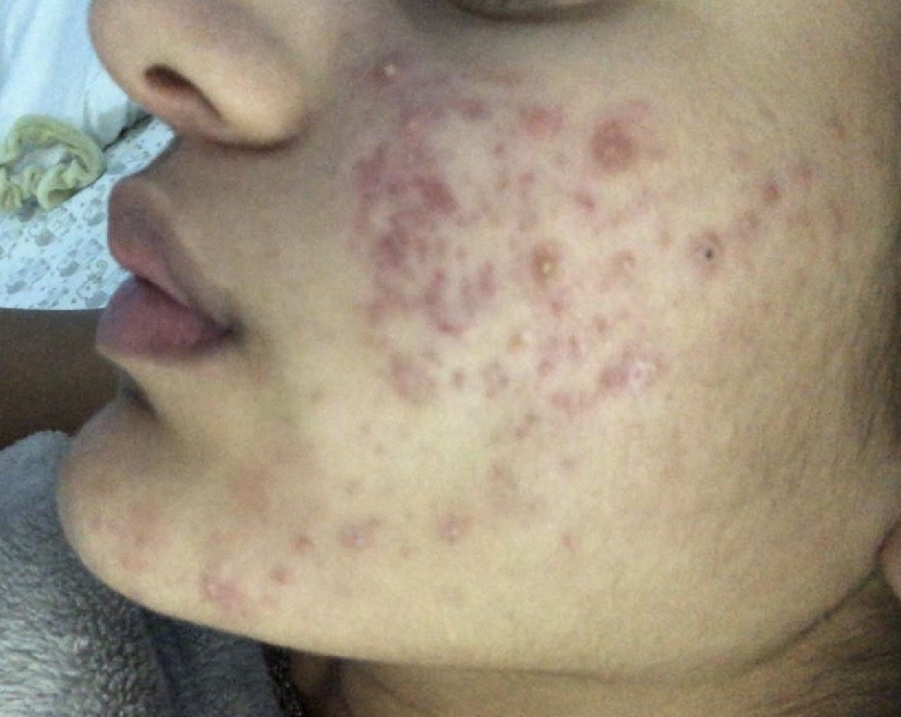 Severe acne in the cheek before treatment
