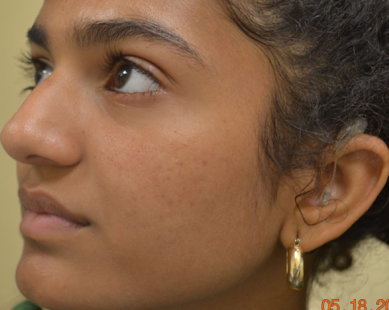 Improvement in acne in cheeks after a series of laser and chemical peels treatments
