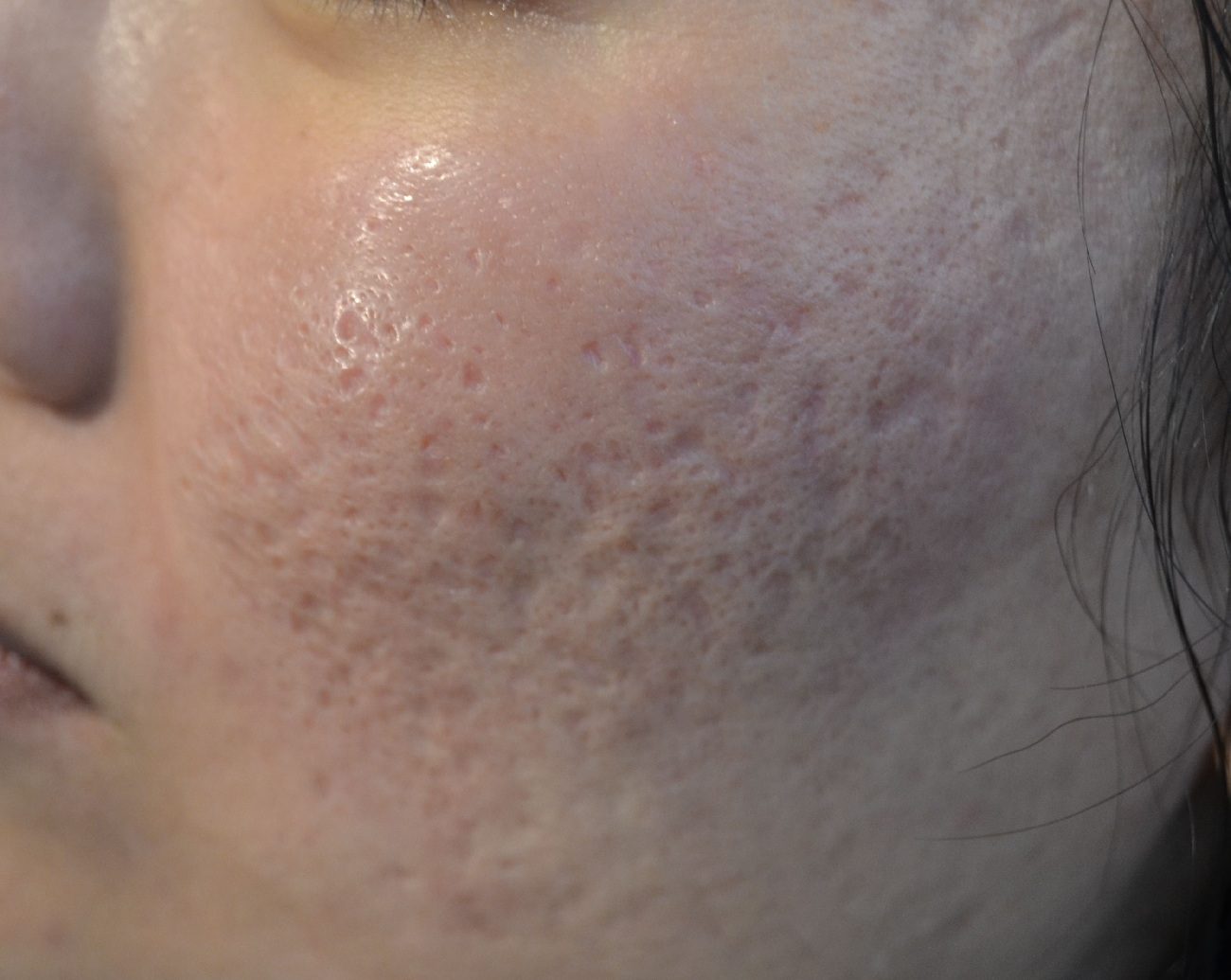 Deep acne scars in a woman in cheeks before Fraxel laser treatments in East Brunswick NJ