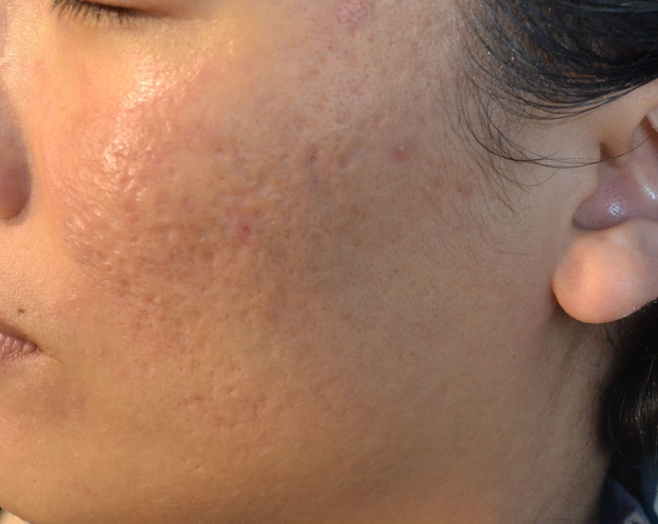 Improved acne scars in cheeks in a woman after four Fraxel laser treatments in East Brunswick NJ