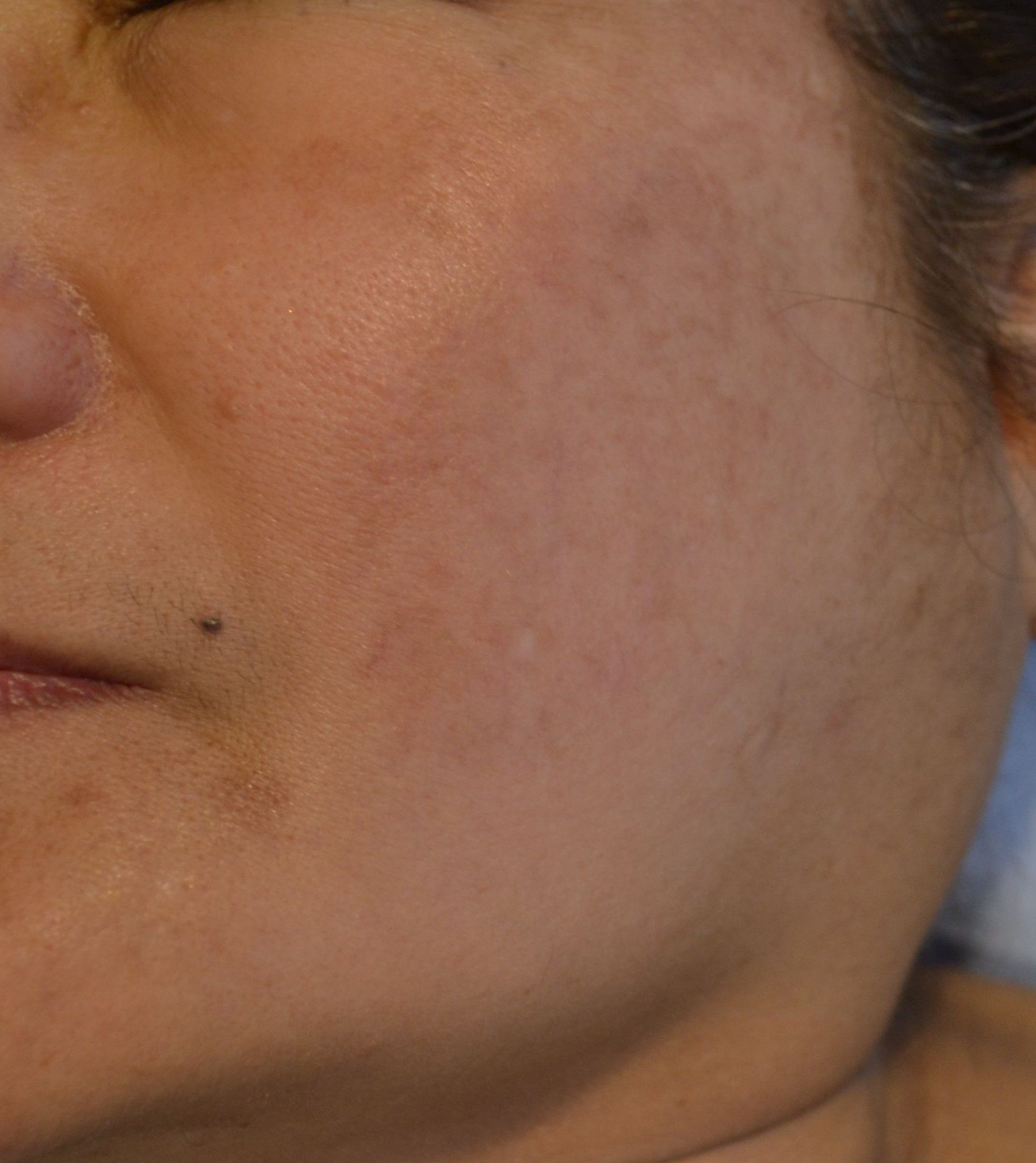 Improved melasma in a woman after a series of laser and chemical peel treatments over 10 months in East Brunswick NJ