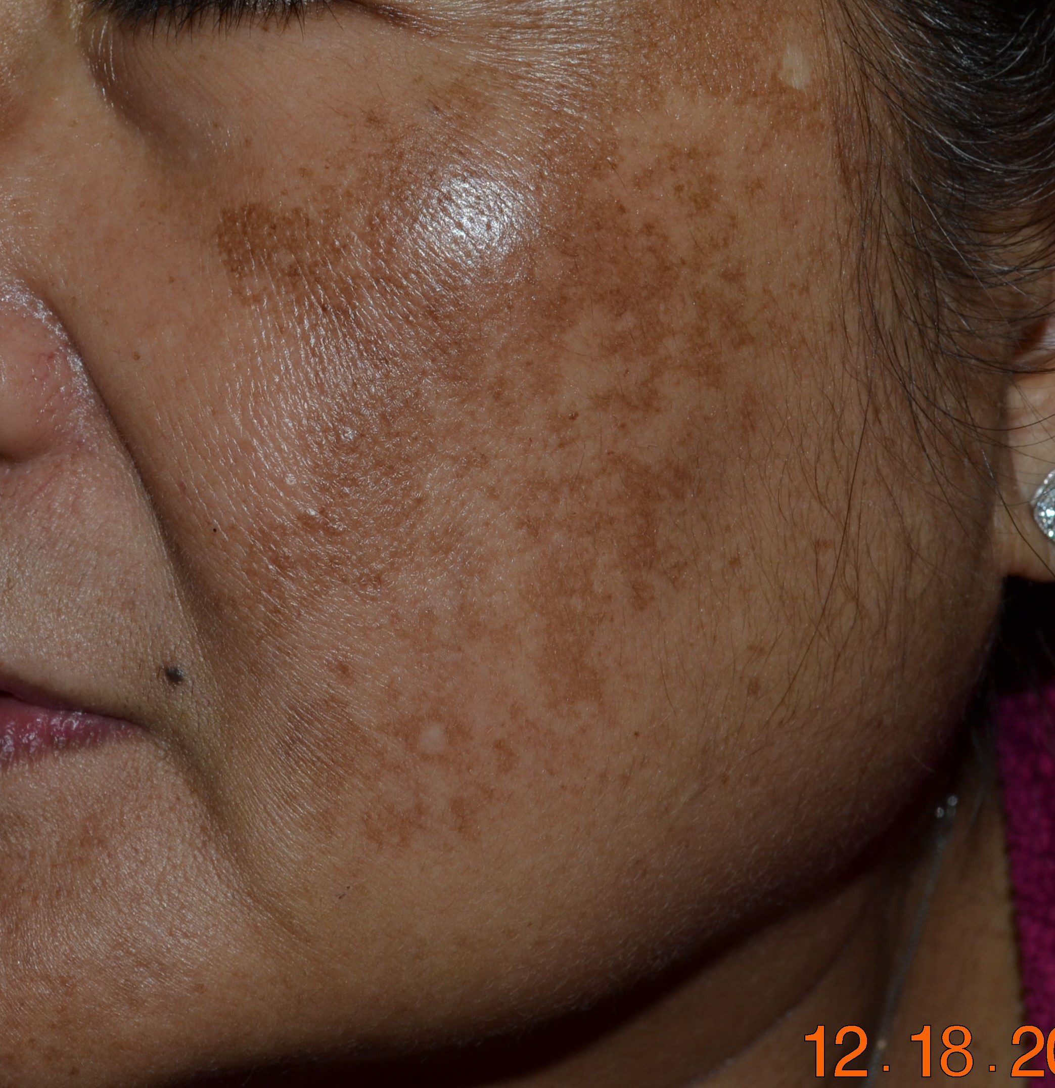 Melasma in the cheek in a woman before laser and chemical peel treatments in East Brunswick NJ