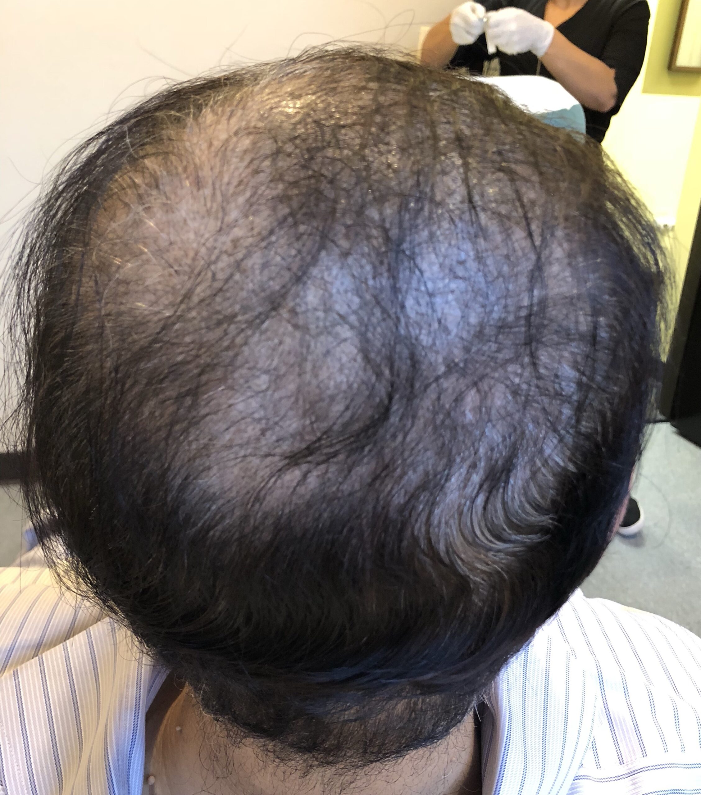 Improved hair growth in a man in the back of the head after a series of PRP treatments