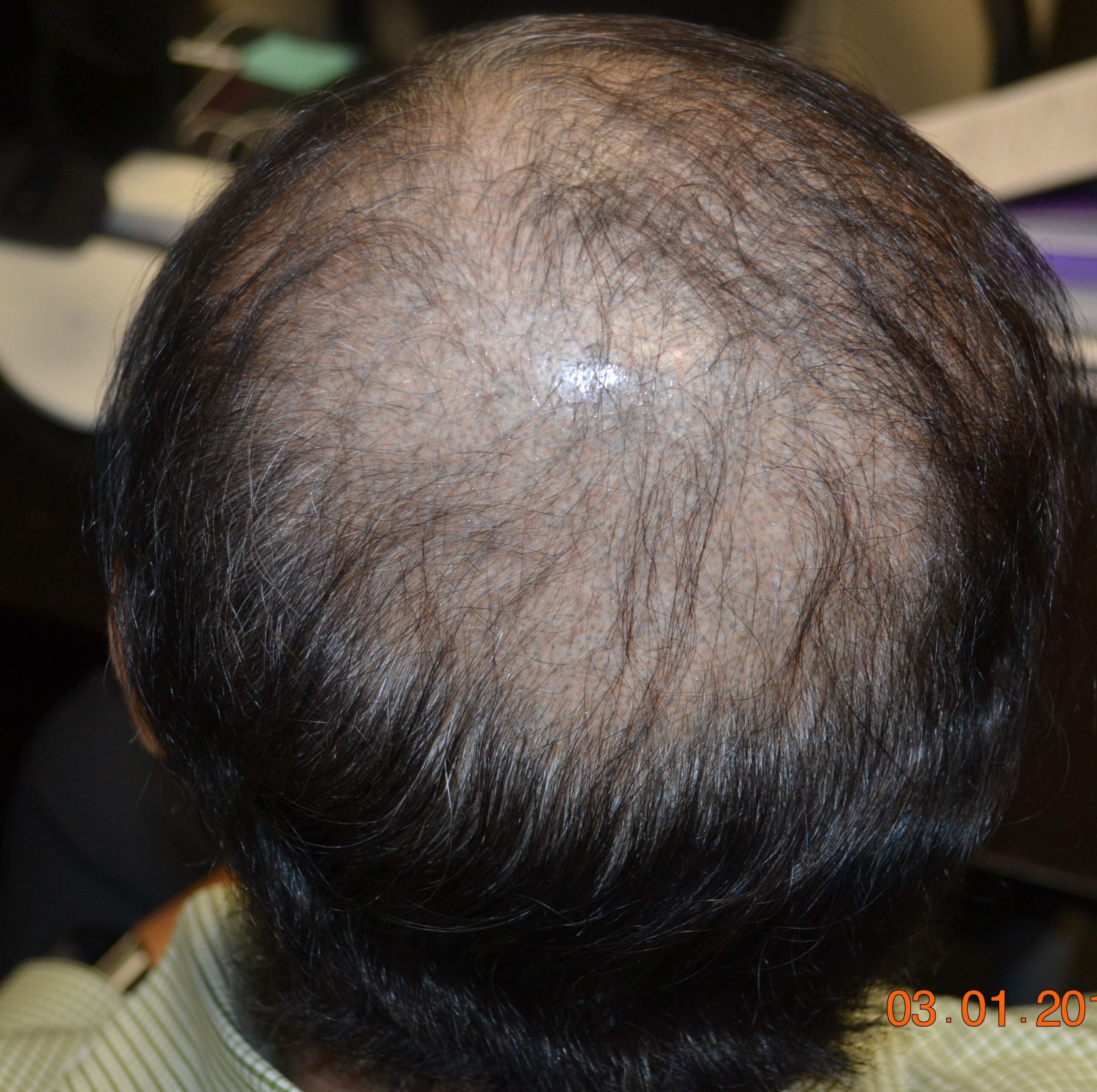 Hair loss in the head in a man before PRP sessions at East Brunswick NJ