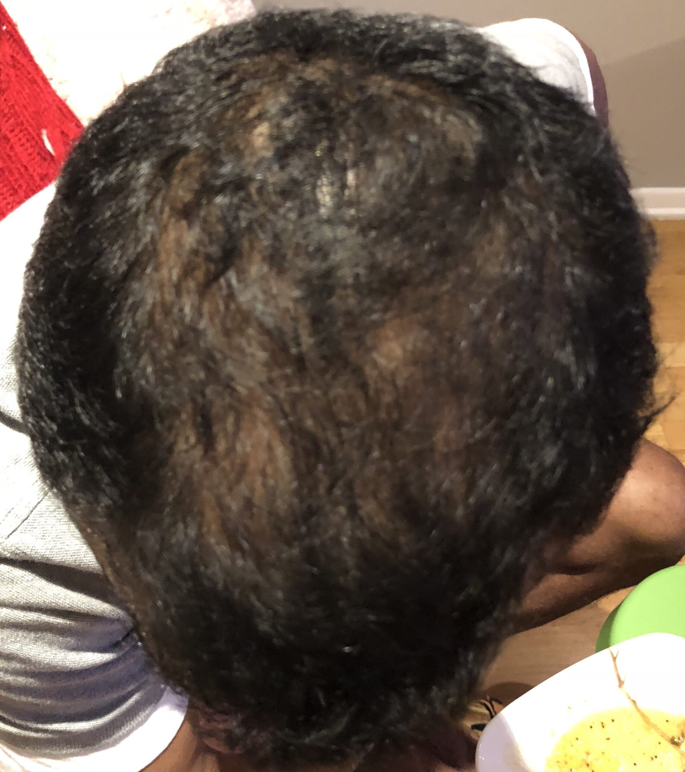 Top view of the head showing plenty of hair growth after PRP treatments in East Brunswick NJ