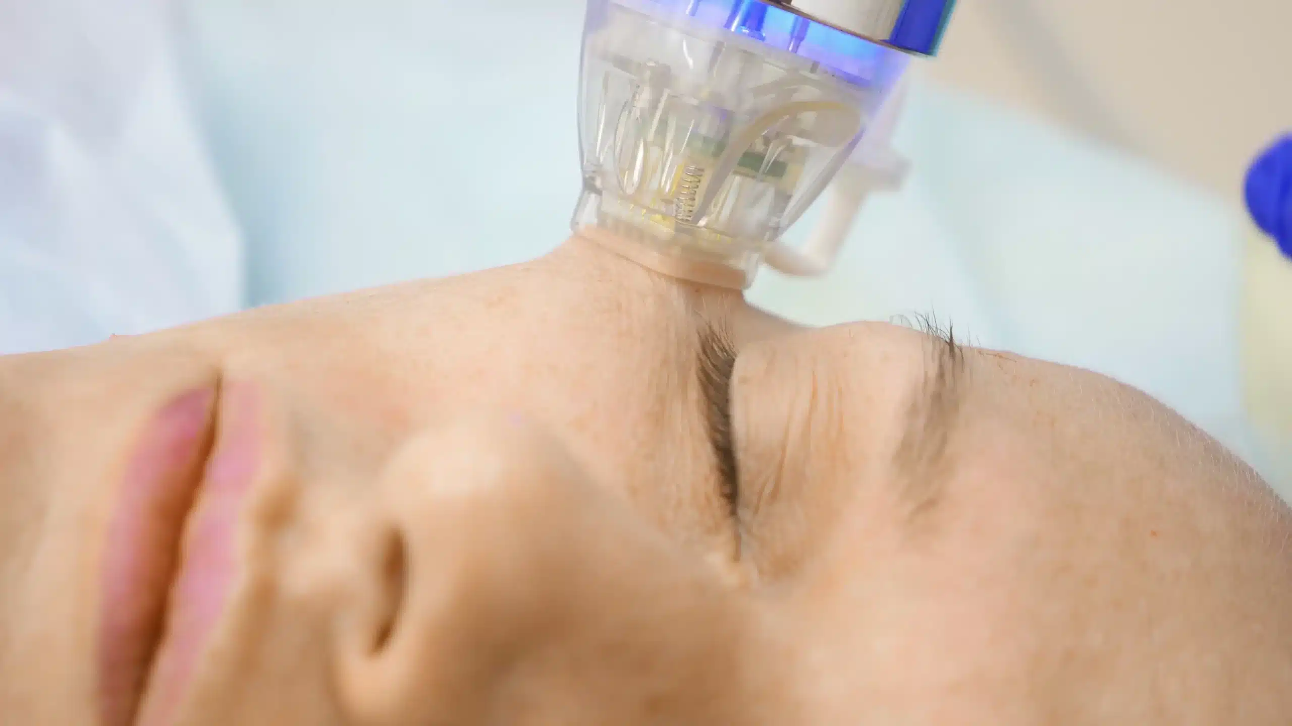 RF-Microneedling RF Microneedling East Brunswick NJ