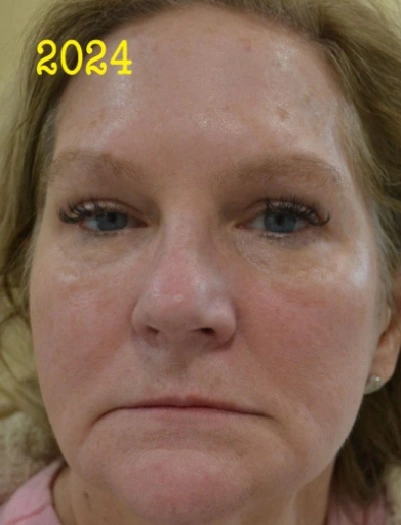 Front view of face 14 years later with regular laser and cosmetic treatments in East Brunswick NJ